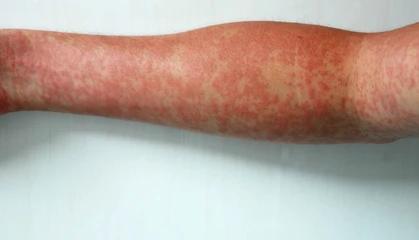Arm with Measles rash