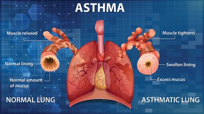 Asthma is a chronic condition of the airways, constricting the tubes that allow the passage of air in and out of our lungs, making it difficult to breathe.