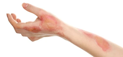 Treatment for burns and scalds is an important part of First Aid training. It can mean the difference between life and death in the case of life threatening burns.