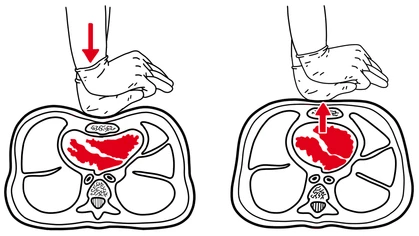 Cutaway diagram showing chest under CPR compressions