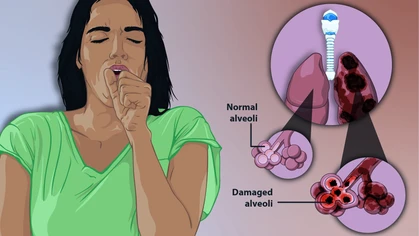Depiction of a woman suffering from Emphysema, a type of Chronic Obstructive Pulmonary Disease.