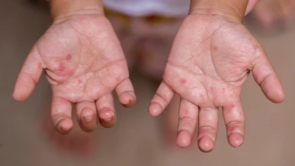 A rash on the hands is characteristic of hand, foot, and mouth disease.
