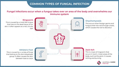 Fungal infections occur when an invading fungus takes over an area of the body and overwhelms the immune system. Today, we look at the most common types of fungal infection, and how to stop them from interfering with your daily life. 