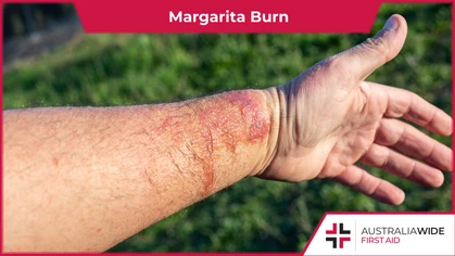 Margarita burn is a type of contact dermatitis. It can occur when a person experiences sun exposure after coming into contact with a causative plant, such as limes. In some cases, Margarita burn can cause blisters and second degree burns. 