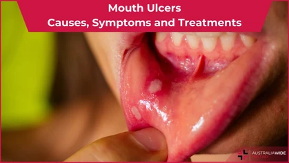 Mouth Ulcers article header