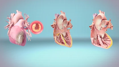 Medical animation still depicting heart attack, cardiac arrest and heart failure.