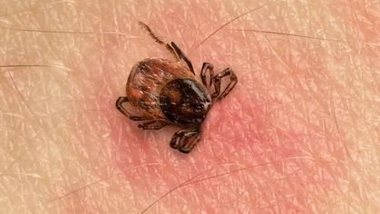 Paralysis ticks can cause an allergic reaction, ranging from mild itching with localised swelling and pain to life-threatening anaphylaxis.
