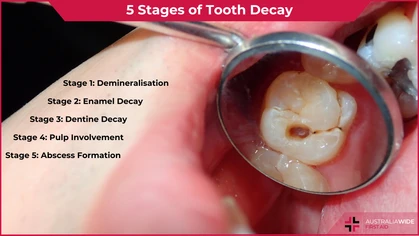 Tooth decay article header