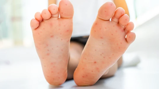 Hand foot mouth disease feet